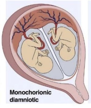 monochorionic diamniotic twins mcda modi icombo