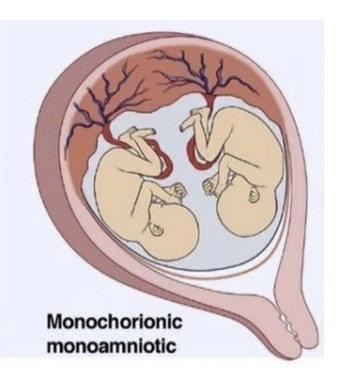 monochorionic monoamniotic twins momo mcma icombo